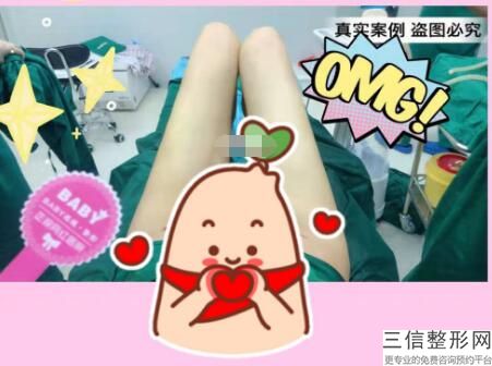 手臂吸脂多久能恢复正常，手臂吸脂恢复期是多久