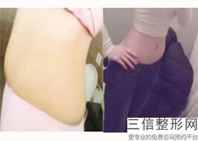 手臂吸脂后的注意事项有哪些，做完手臂吸脂注意事项