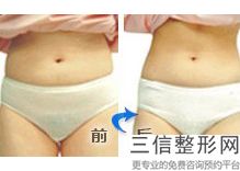 瘦手臂除了吸脂还有什么办法，胳膊吸脂效果图