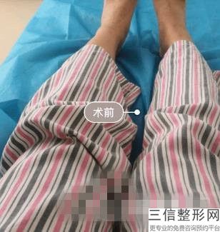 瘦手臂除了吸脂还有什么办法，胳膊吸脂效果图