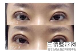 双眼皮没做好要怎么解决，双眼皮手术没做好可以修复吗