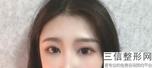 双眼皮线条过长怎么办，双眼皮线很长