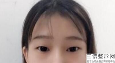 双眼皮线条过长怎么办，双眼皮线很长