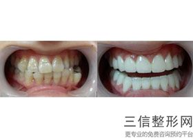 死髓牙为什么还会疼，死髓牙补牙疼吗