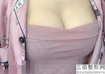 缩乳手术有危险吗，缩胸手术对乳腺有影响么