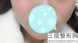 兔唇能整形吗，成人兔唇整形哪个医院良好