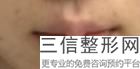 兔唇能整形吗，成人兔唇整形哪个医院良好