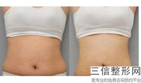 臀能吸脂吗，臀部吸脂哪里好