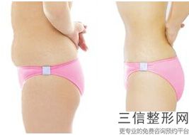 臀能吸脂吗，臀部吸脂哪里好
