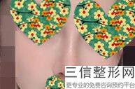 歪鼻可以完全矫正吗，歪鼻矫正属于整容吗