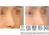 歪鼻可以完全矫正吗，歪鼻矫正属于整容吗
