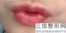 为什么玻尿酸丰唇肿的时间长，玻尿酸丰唇会肿多久