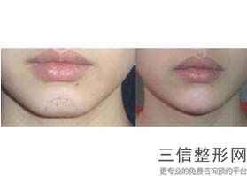 为什么玻尿酸丰唇肿的时间长，玻尿酸丰唇会肿多久