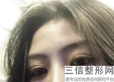 为什么会出现下眼睑外翻的现象-(图)，眼睑外翻是什么原因导致的-(图)