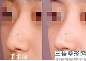未成年可以做鼻子嘛,未成年可以做什么整容手术