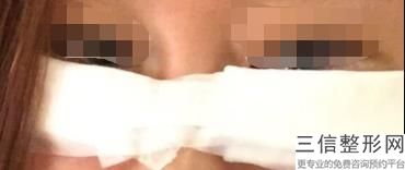 无痕祛眼袋的效果怎么样，无痕去眼袋好不好