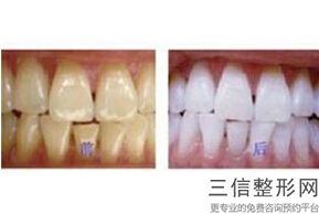 无托槽隐形矫治器品牌，透明托槽矫正牙齿多少钱
