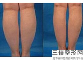 吸脂真的可以瘦腿吗，吸脂能瘦大腿吗