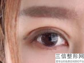 下眼睑整容叫什么，整容眼睑下至多少钱