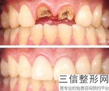 现在做个烤瓷牙套多少钱，做个烤瓷牙套大概多少钱一个
