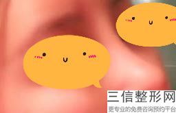 线雕隆鼻好吗-,做线雕隆鼻会不会有副作用好不好呢