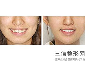 牙齿矫正在公立医院好还是私立医院好(牙齿矫正去公立医院好还是私立医院好)