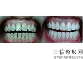 牙齿做过美容冠不能矫正了吗-，牙齿做美容冠好吗