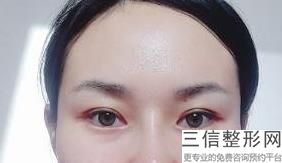 眼部整形一般价格多少钱，眼部整形多少钱