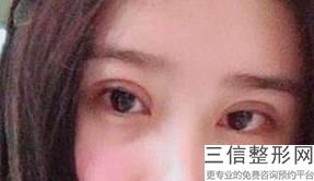 眼睑内翻一定要手术吗，下眼睑外翻可以自愈吗