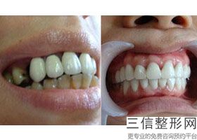 隐形矫正牙齿的弊端，隐形牙齿矫正好还是传统