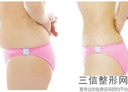 怎么样才能瘦小腿肌肉，怎样可以快速瘦大腿和小腿上的肉