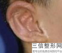 招风耳整形方法，招风耳手术矫正方法