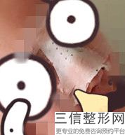 整鼻尖鼻翼多少钱，隆鼻鼻子多少钱