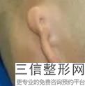 郑州哪个医院做耳膜手术良好，一般医院做附耳切除要多少钱
