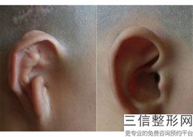 郑州哪个医院做耳膜手术良好，一般医院做附耳切除要多少钱