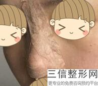 注射填充鼻子的几种方式，填充鼻子好吗