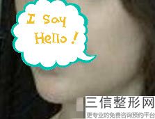 嘴唇改薄整形多少钱，厚唇改薄手术多少钱啊