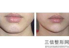 嘴唇改薄整形多少钱，厚唇改薄手术多少钱啊