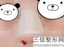做完鼻子整容手术注意事项，鼻子整形术后注意事项
