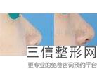 2022年北京misko埋线隆鼻整形医院评价！武警总医院整形美容中心正规靠谱价格也不贵！