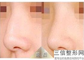 2022年北京爱贝芙鼻部注射整形医院哪家好？北京八大处整形外科医院等实力入选~附价格
