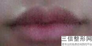 2022年北京爱贝芙注射丰唇整容医院榜单！北京瑞丽舍整形美容医院举世闻名