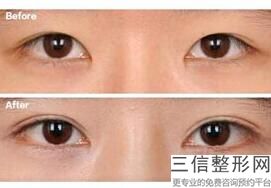 2022年北京半长久纹眼线美容整形排行榜！北京丽都医疗美容医院公立对比全国私立连锁