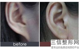 2022年北京杯状耳矫正术美容整形医院排名！北京庆熙整形美容门诊部收集了排名靠前的医院名单及价格费用请对比