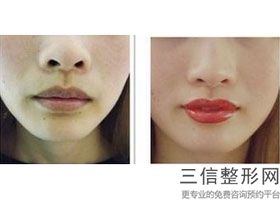 2022年北京鼻唇沟填充整形美容医院排名！北京庆熙整形美容门诊部再次蝉联前三甲_价格表爆出
