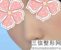 2022年北京鼻基底填充术美容医院前三！北京米扬丽格医疗美容看哪家医院技术好性价比高？