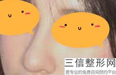 2022年北京鼻尖下垂整形整形医院！北京丹熙医疗美容诊所公立口碑好、技术专业、价格合理