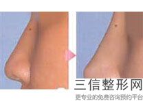 2022年北京鼻孔修复美容整形医院哪家好？解放军总医院第一附属医院排行榜前五强权威汇总盘点！