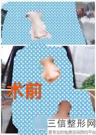2022年北京鼻小柱短宽矫正术医院排名前三位！北京澳保加医疗美容诊所公立私立对比汇总