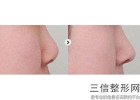 2022年北京鼻小柱畸形矫正美容整形医院排名！北京印正山医疗美容诊所数一数二